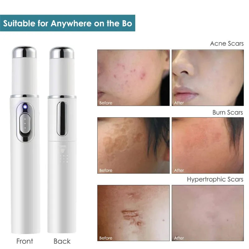 TG Acne Laser Blue Light Therapy Pen